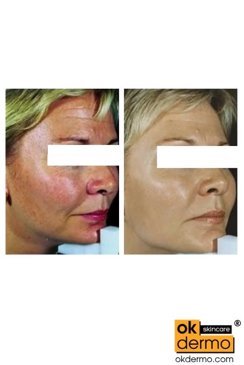 12 Lactic Acid (Ammonium Lactate) Cream Lacsoft® 50g OKDERMO®