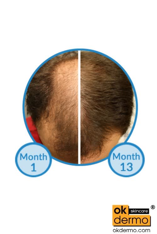 Minoxidil 2/5/10 Hair Regrowth Topical USP Solution Mintop® 60g