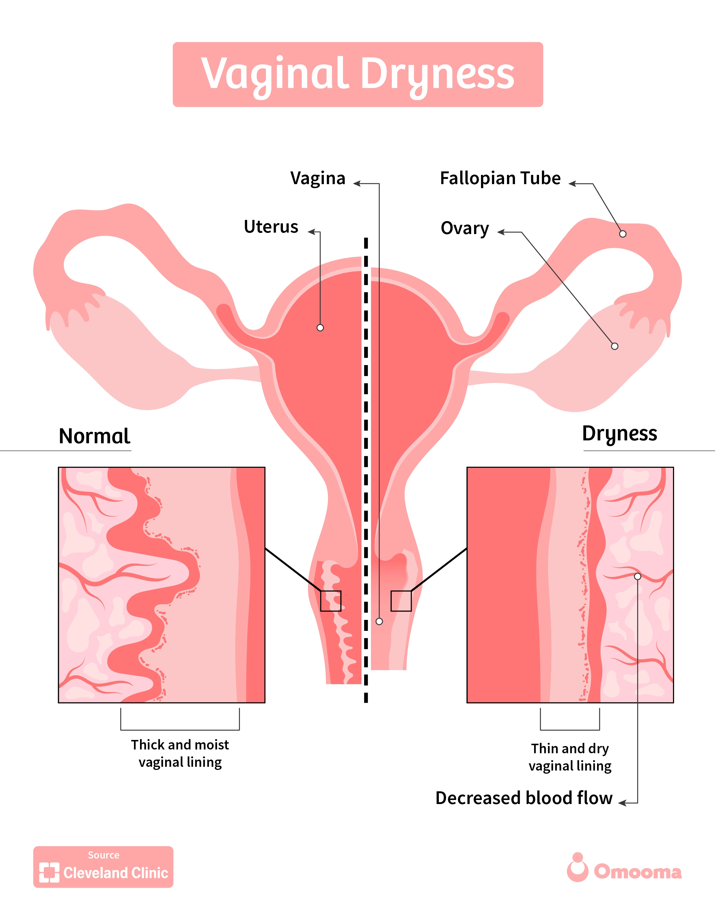 vaginal dryness