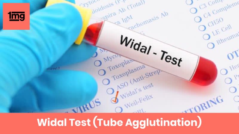 Widal Test (Tube Agglutination)