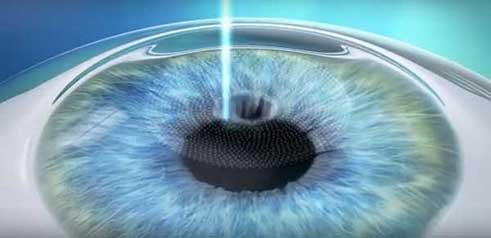 SMILE : chirurgie laser sans douleurs post-opératoires avec récupération visuelle très rapide