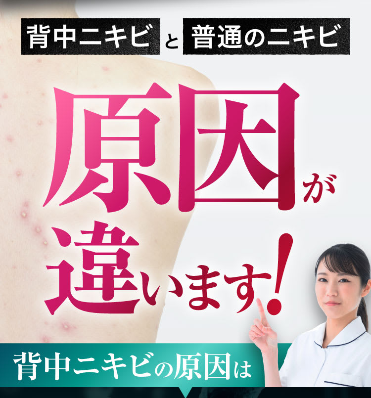 背中ニキビと普通のニキビ、原因が違います！