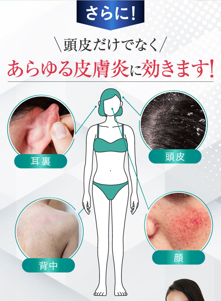 さらに！頭皮だけでなくあらゆる皮膚炎にも効きます！｜ポテンツァ錠0