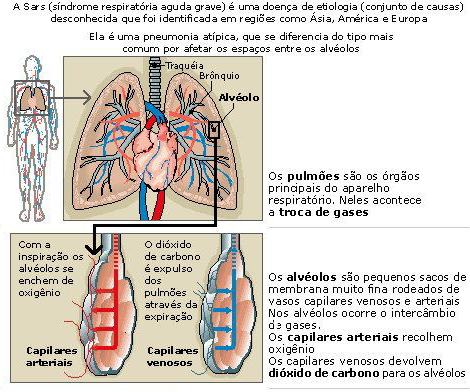 Sars (síndrome respiratória aguda grave)