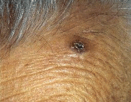 Carcinoma Basocelular