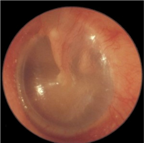 Foto som visar en normal trumhinna.