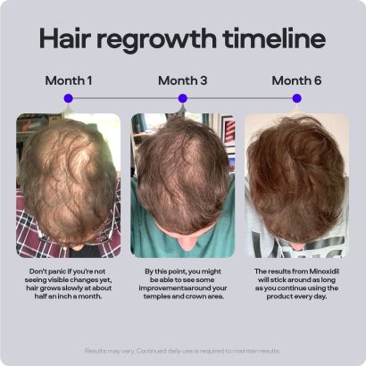 Rear view of Sons Minoxidil 5% Solution for hair loss 3x60ml