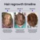 Rear view of Sons Minoxidil 5% Solution for hair loss 3x60ml