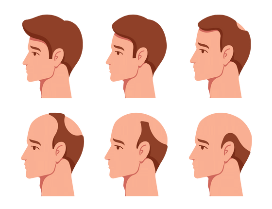 Stages of male pattern hair loss