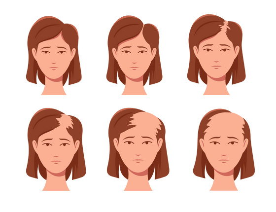 Stages of female pattern baldness