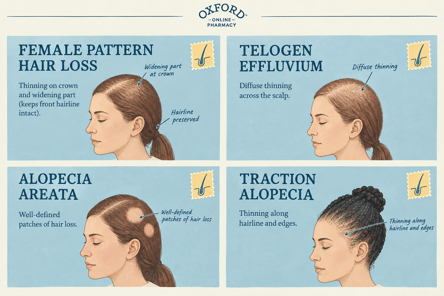 Infographic showing the 4 different types of hair loss in women