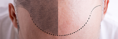 Scalp line of man with receding hair