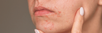 woman with perioral dermatitis