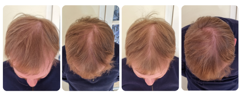 image of the top of mans head showing hair loss