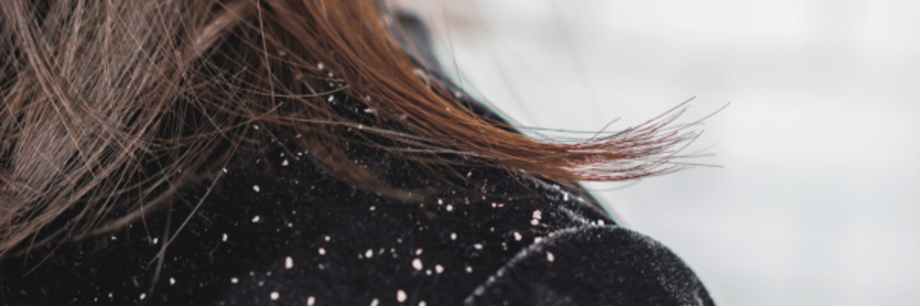 Dandruff on Woman's shoulder