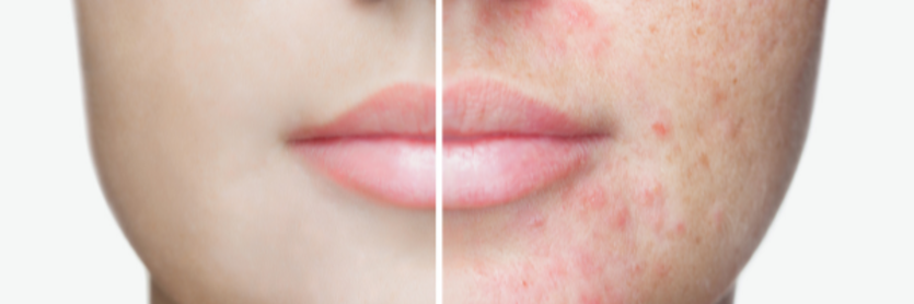 Acne