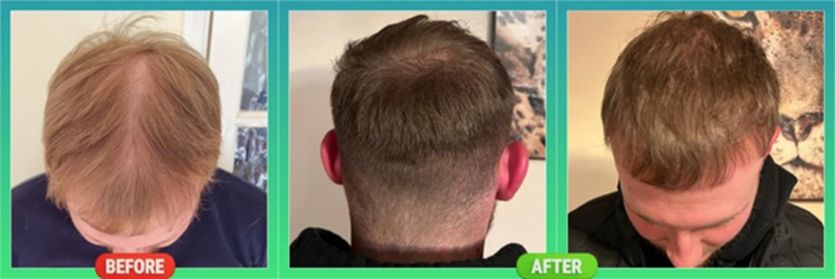 Three photos of the top of a man's head are in a row. The photo on the left is labelled "before" and the middle and right photos are labelled "after". The head in the "after" photos appears to have thicker hair and a fuller hairline than the "before".