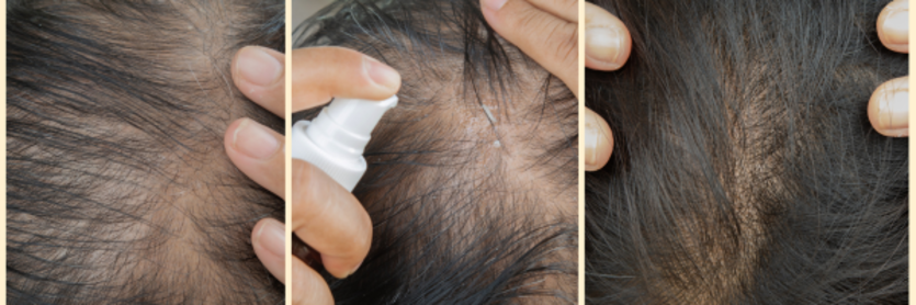 A close up of hair loss on the top of a scalp