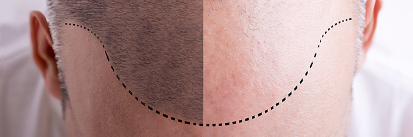 Scalp line of man with receding hair