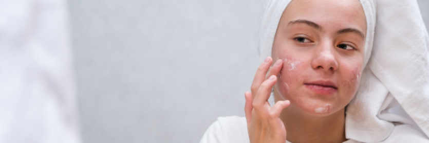 lady applying acne solution
