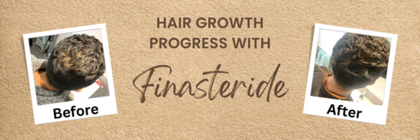 Finasteride: Before and After Images