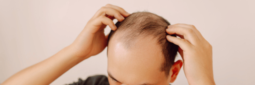 Guy with balding head