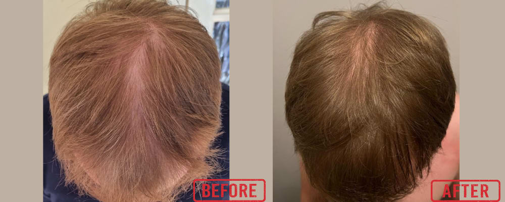 ED's hair treatment journey ED's hair treatment journey