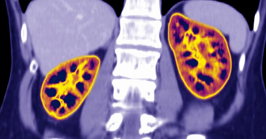 How an Algorithm Blocked Kidney Transplants to Black Patients