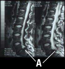 Herniated Lumbar Disc