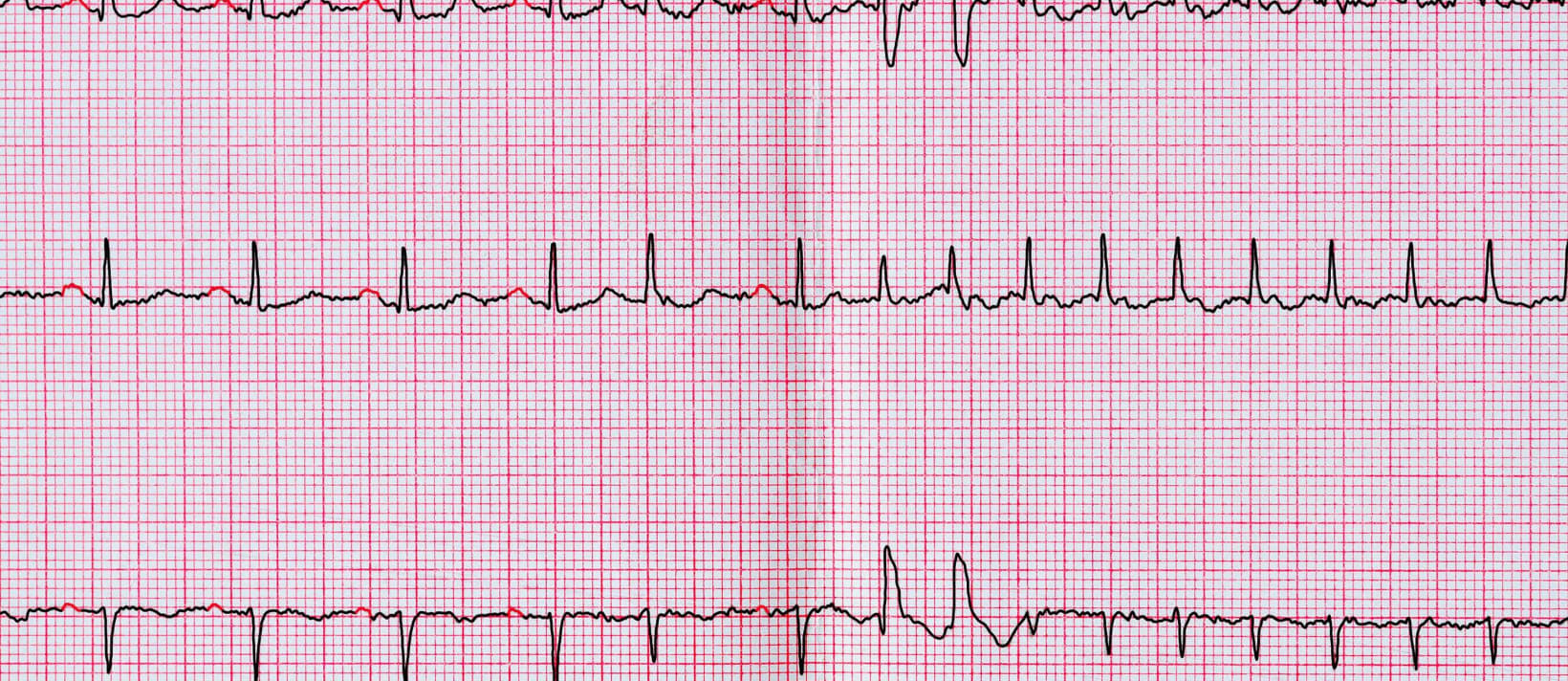 afib with ivcd afib with ivcd