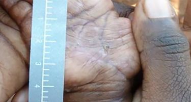 Skin sores after showing scars
. Credit: Menzies School of Health Research
