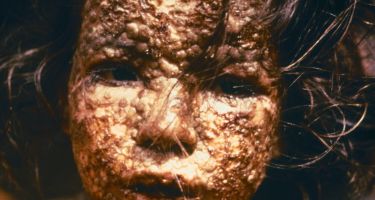 This young girl in Bangladesh was infected with smallpox in 1973…
. Credit: CDC/James Hicks via Wikipedia