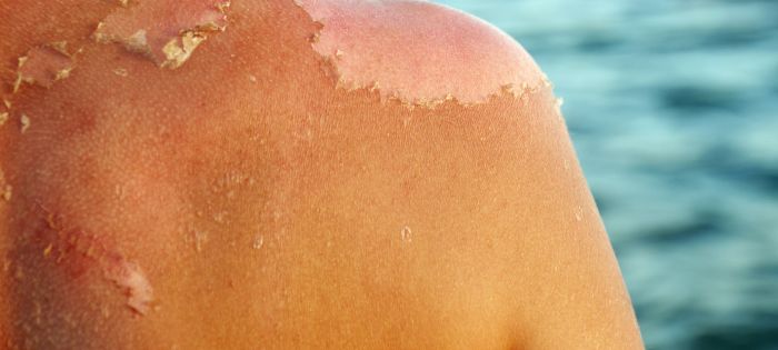 Feeling the burn this summer