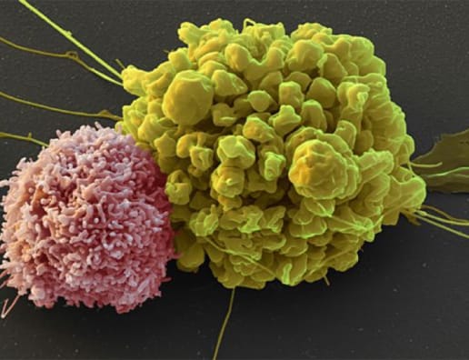 Natural Killer Cells For Prostate Cancer Immunotherapy Prostate Cancer Foundation
