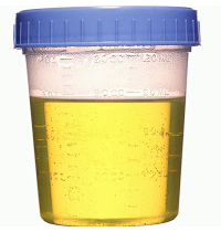 prostate cancer urine test results