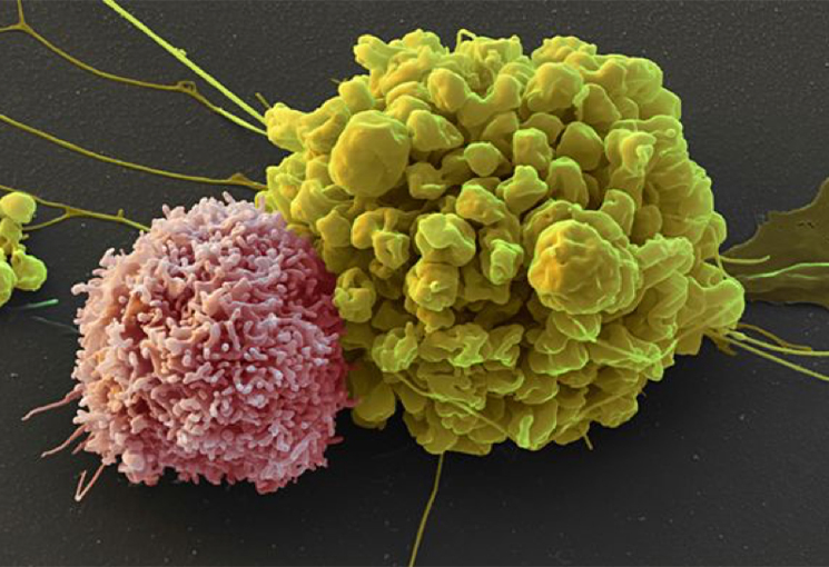 Natural Killer Cells for Prostate Cancer Immunotherapy Prostate