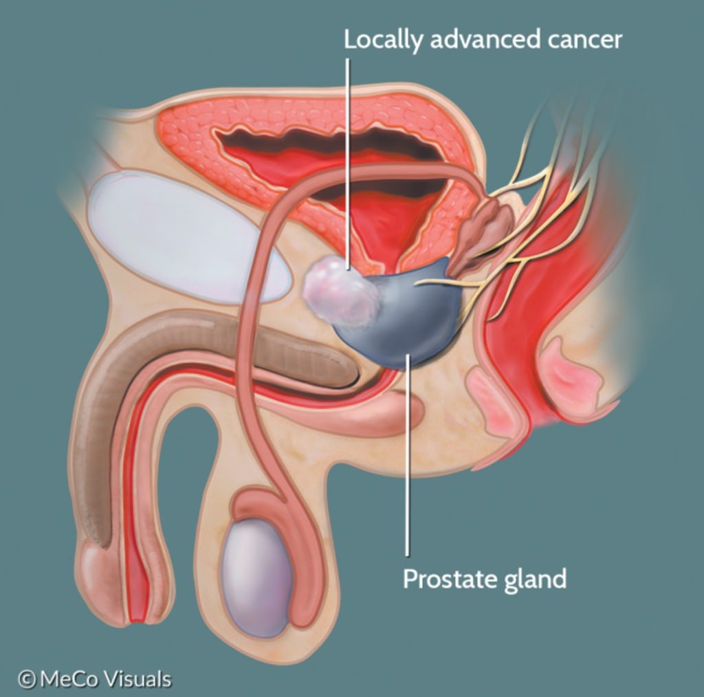 What is Localized or Locally Advanced Prostate Cancer? | PCF