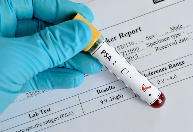 prostate cancer urine test results