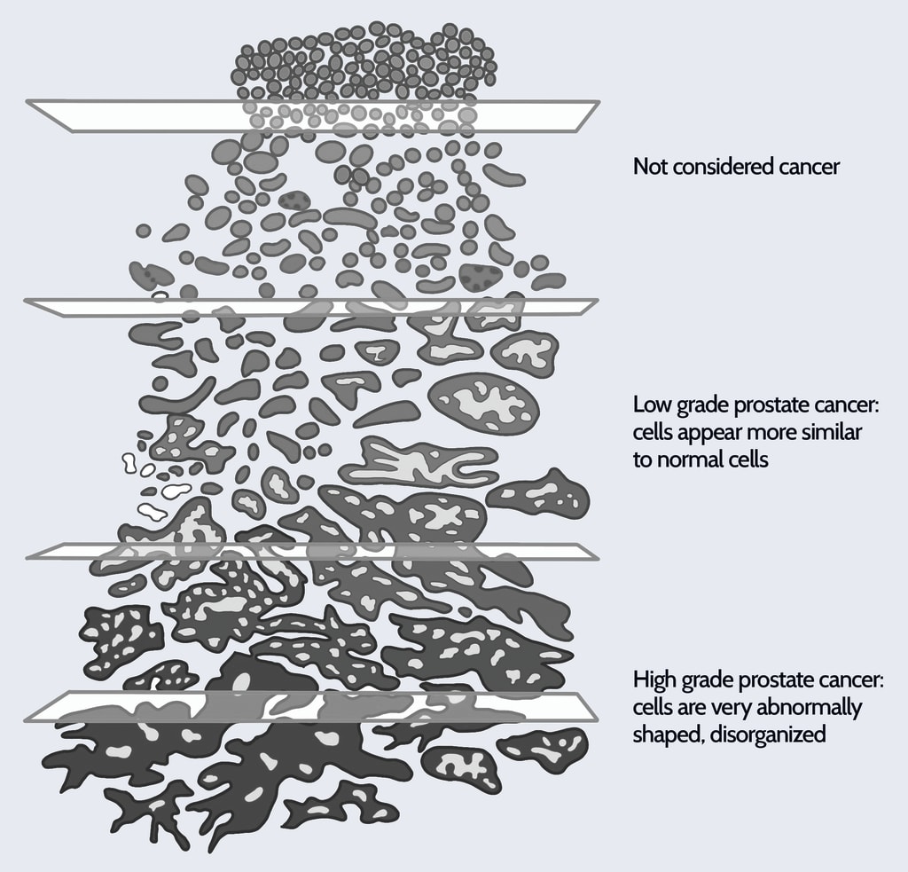 What Is A Gleason Score Prostate Cancer Foundation what-is-a-gleason-score-prostate-cancer-foundation