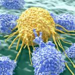 Cancer cell attacked by lymphocytes