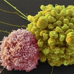 Natural Killer Cells for Prostate Cancer Immunotherapy