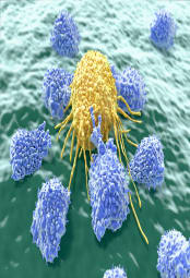 Cancer cell attacked by lymphocytes