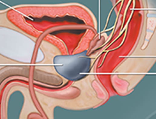 Prostate Mi a bump)