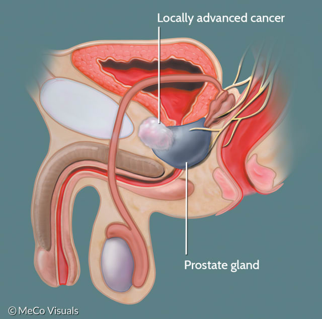 a minimally invasive ablation technique in prostate cancer