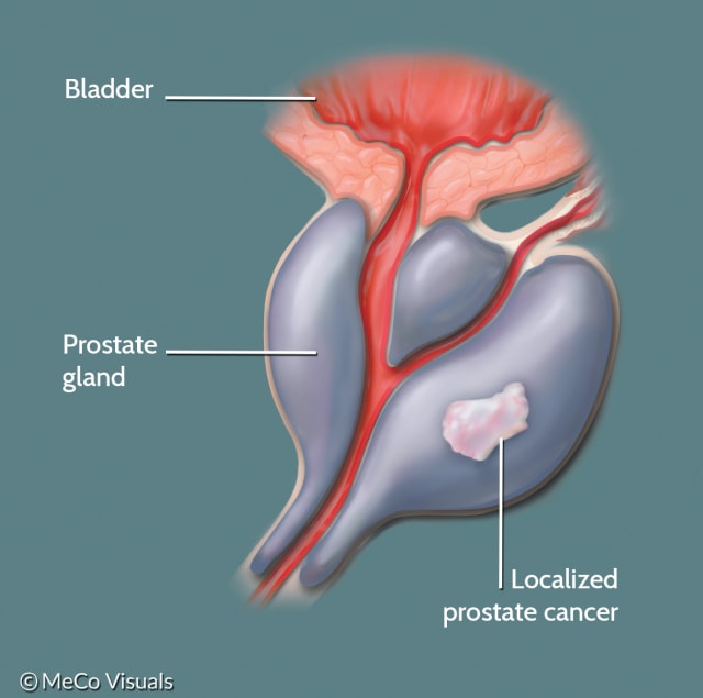 cancer prostate meaning)