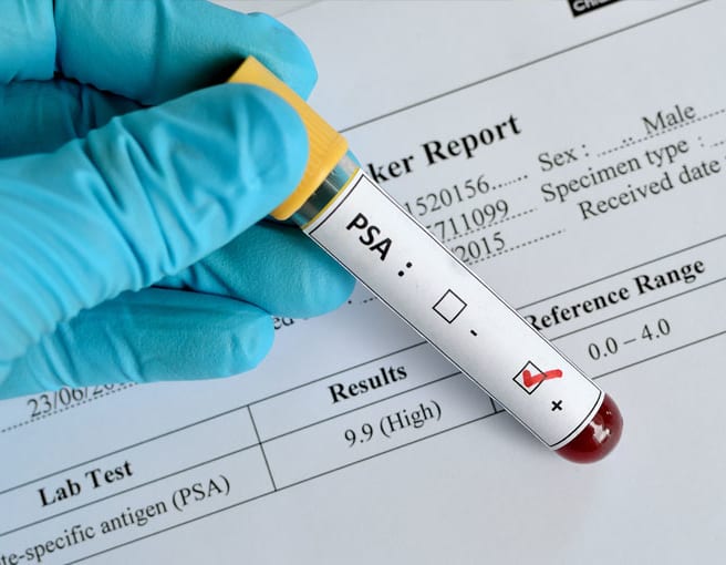 prostate psa test preparation