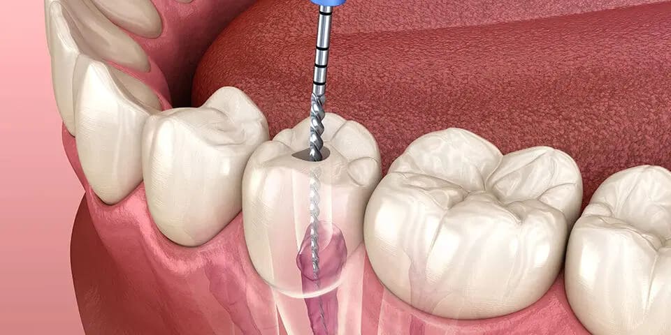 Root Canal Treatment Cost in Indore — Ultimate 2026 Guide