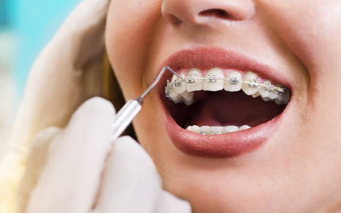 How to Know If You Need Braces — 10 Signs an Orthodontist Looks For