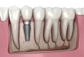 Dental Implants Cost in Indore (2026 Complete Guide)