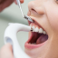 Dental scale and polish at the dental hygienist